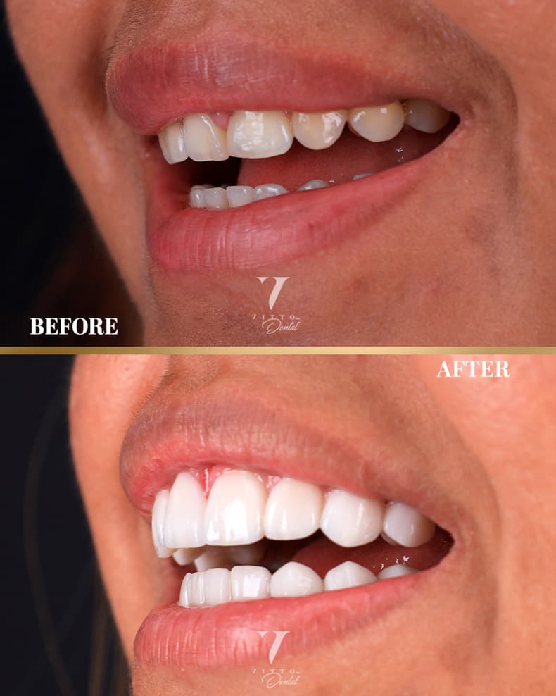 Before and after result at VittoMD in Miami, FL