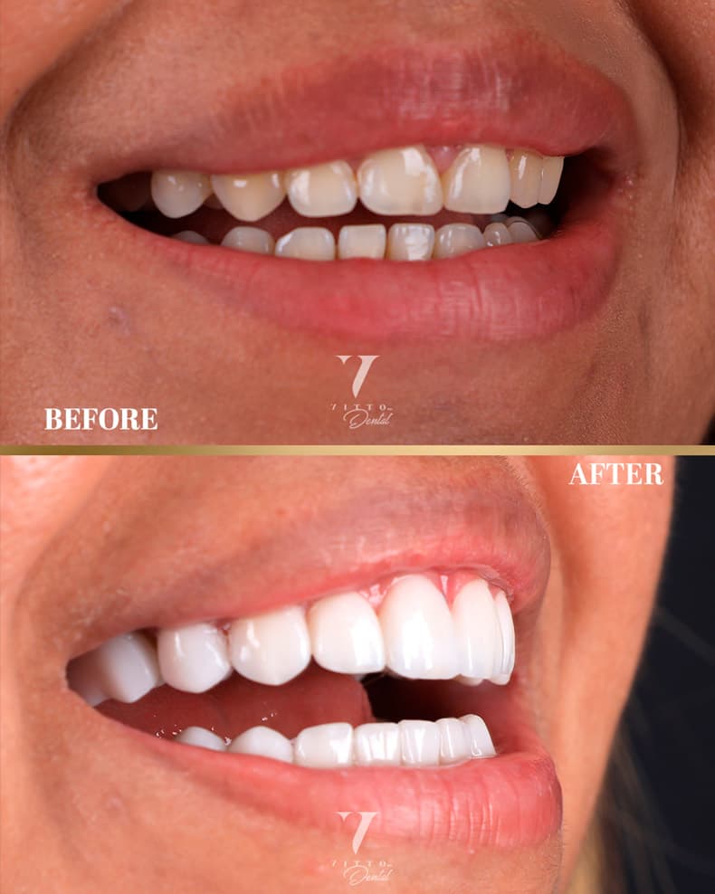 Before and after result at VittoMD in Miami, FL