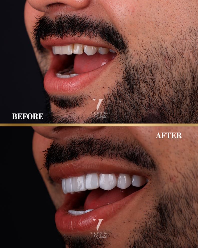 Before and after result at VittoMD in Miami, FL