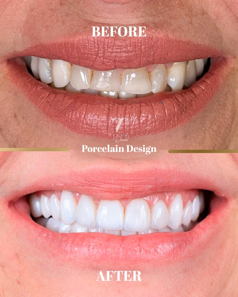 Before and after result at VittoMD in Miami, FL