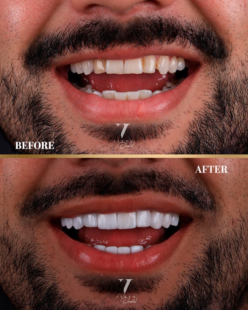 Before and after result at VittoMD in Miami, FL
