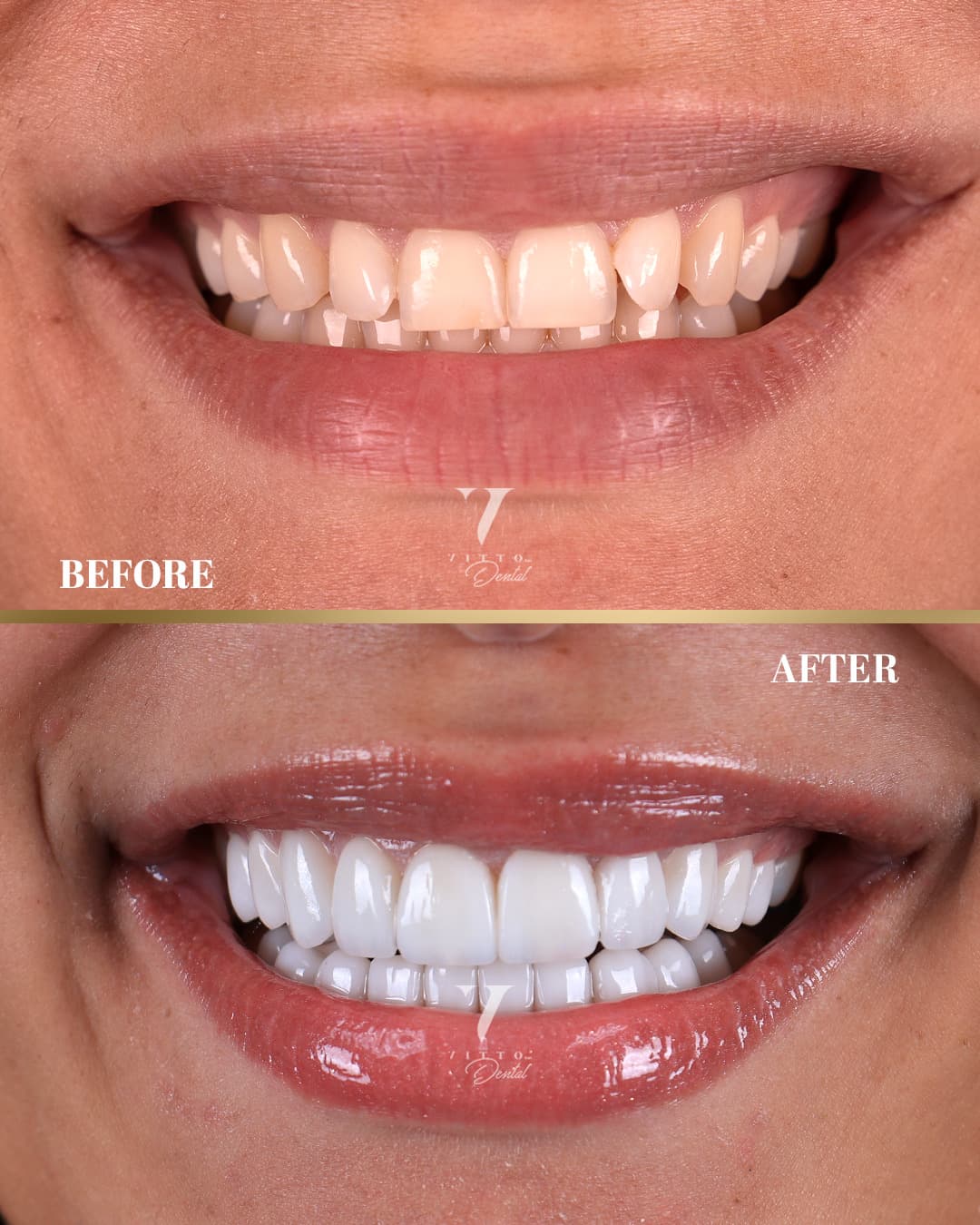 Before and after result at VittoMD in Miami, FL