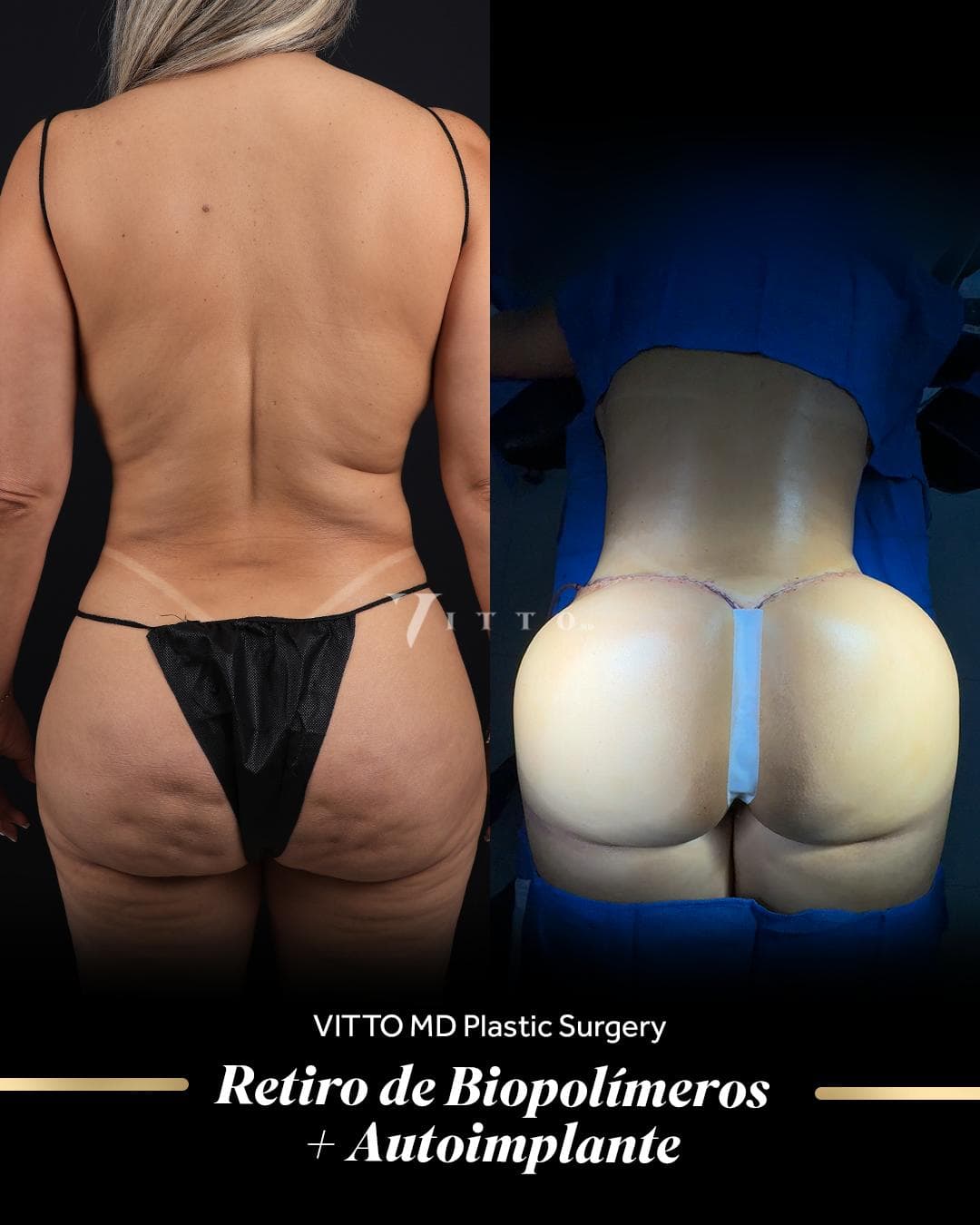 Before and after result at VittoMD in Miami, FL