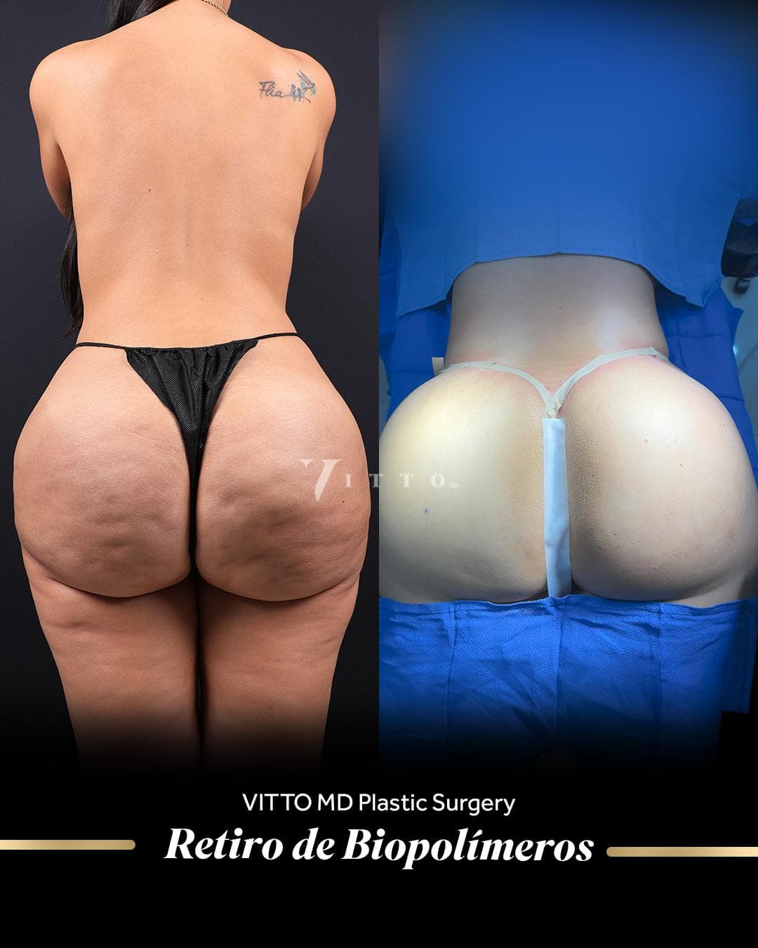 Before and after result at VittoMD in Miami, FL