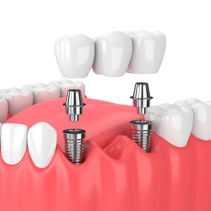 Dental Implant + Crown