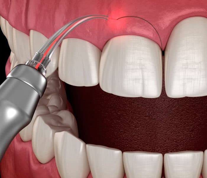 Gingivectomy
