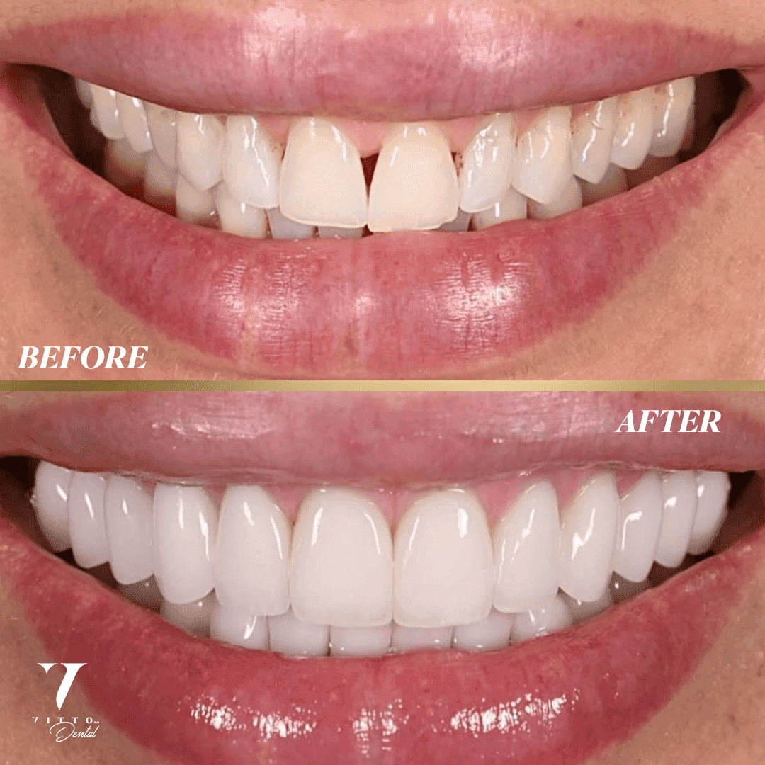 Before and after result at VittoMD in Miami, FL