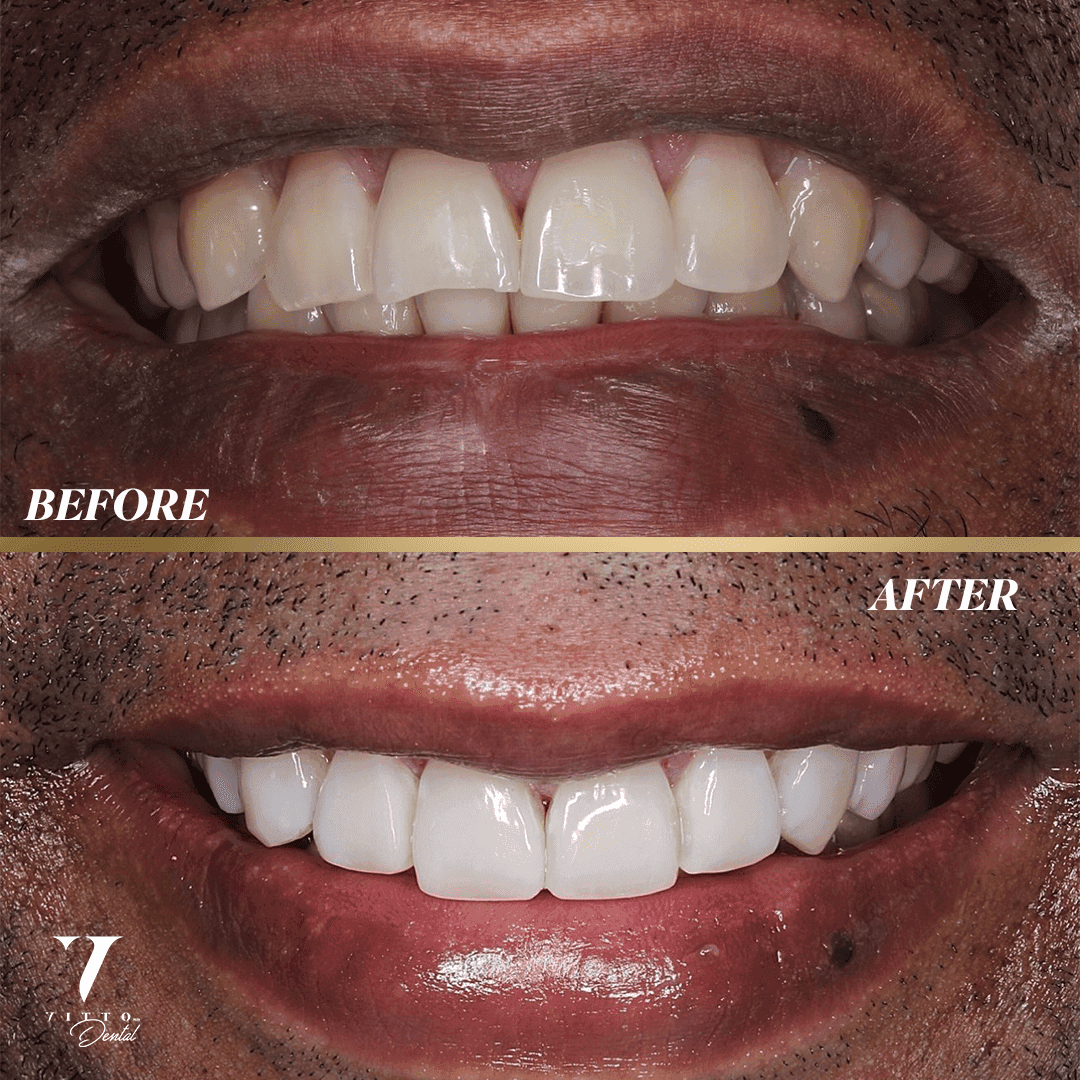 Before and after result at VittoMD in Miami, FL