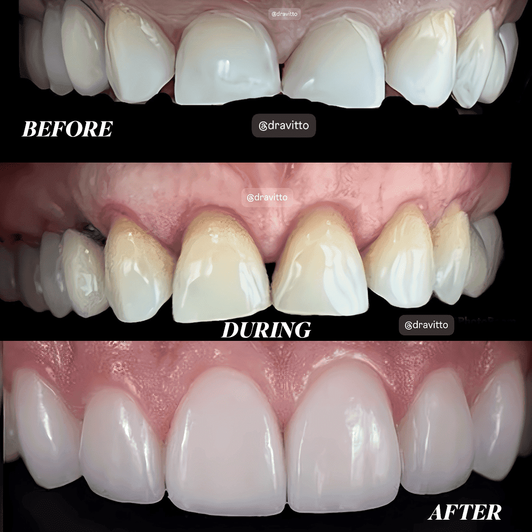 Before and after result at VittoMD in Miami, FL