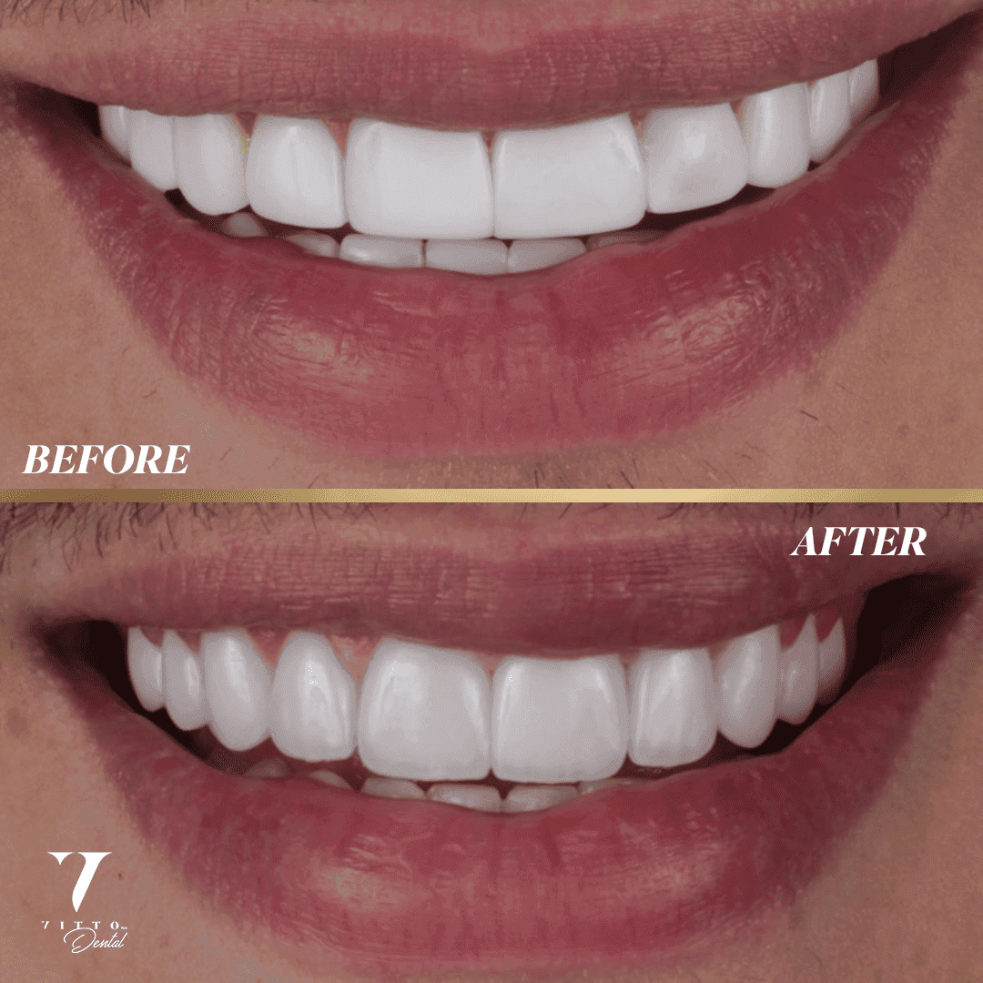 Before and after result at VittoMD in Miami, FL