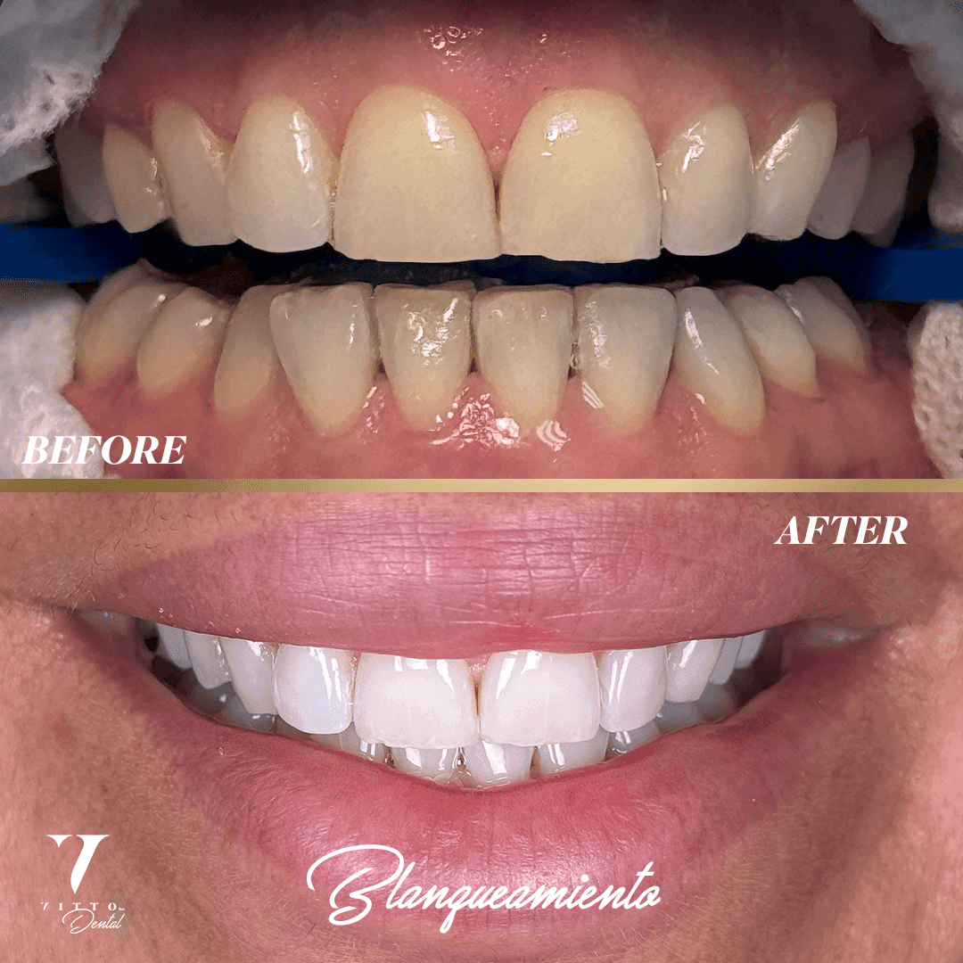 Before and after result at VittoMD in Miami, FL