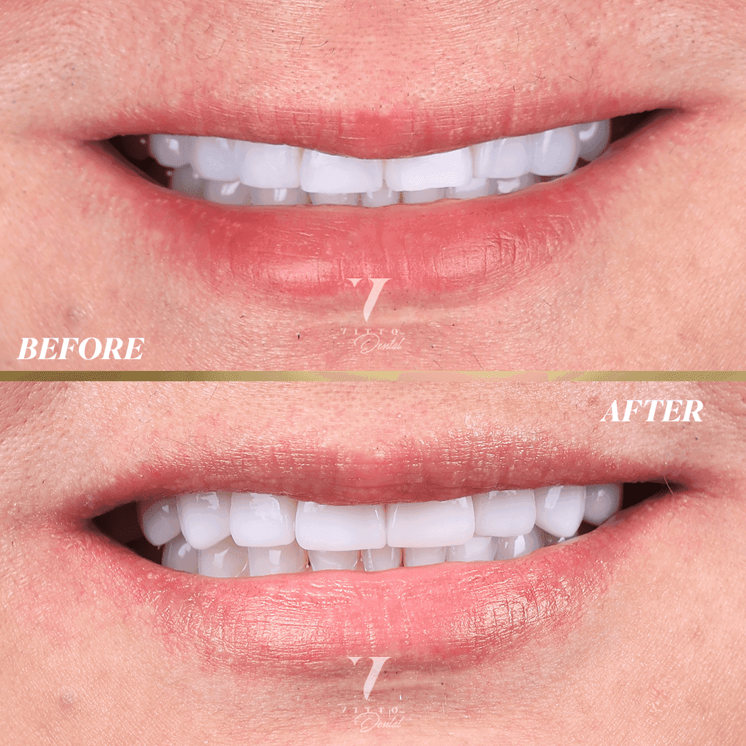 Before and after result at VittoMD in Miami, FL