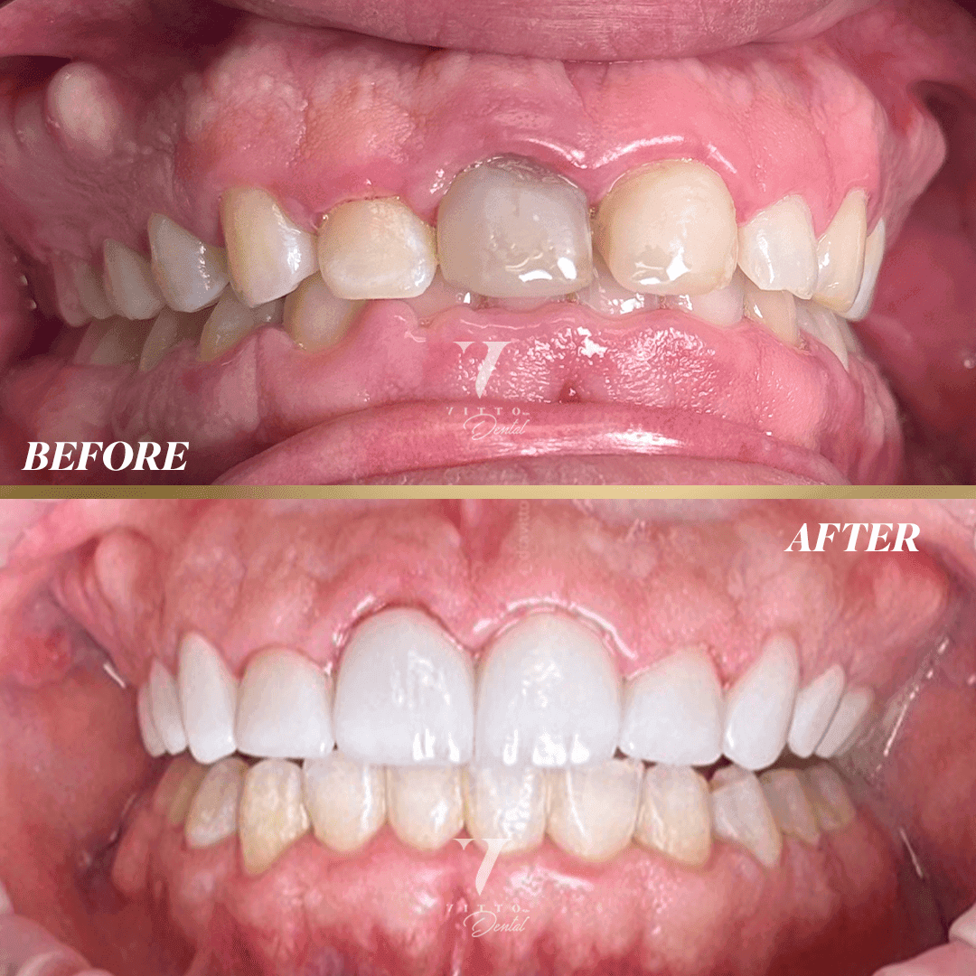 Before and after result at VittoMD in Miami, FL