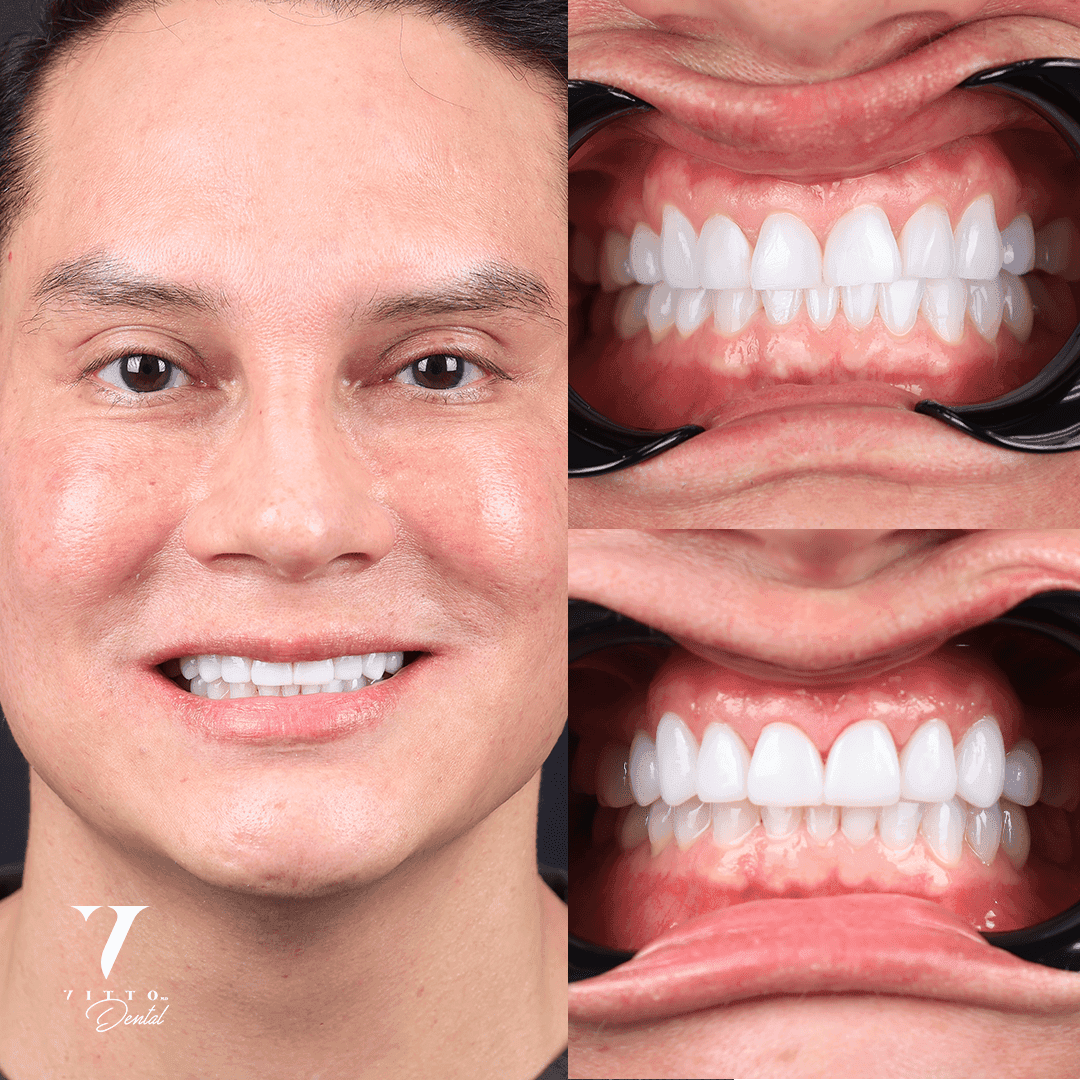 Before and after result at VittoMD in Miami, FL