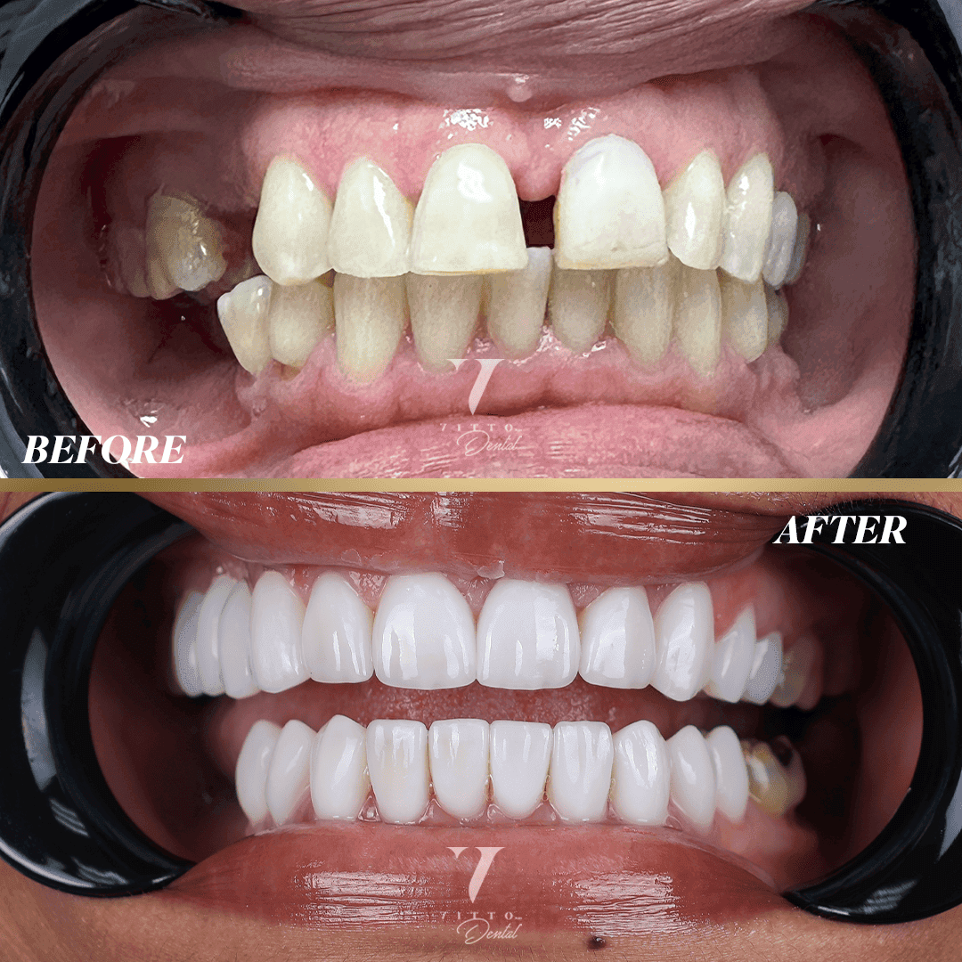 Before and after result at VittoMD in Miami, FL