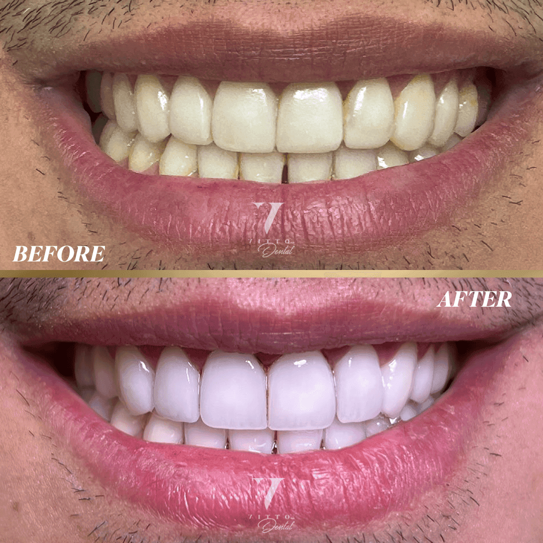 Before and after result at VittoMD in Miami, FL