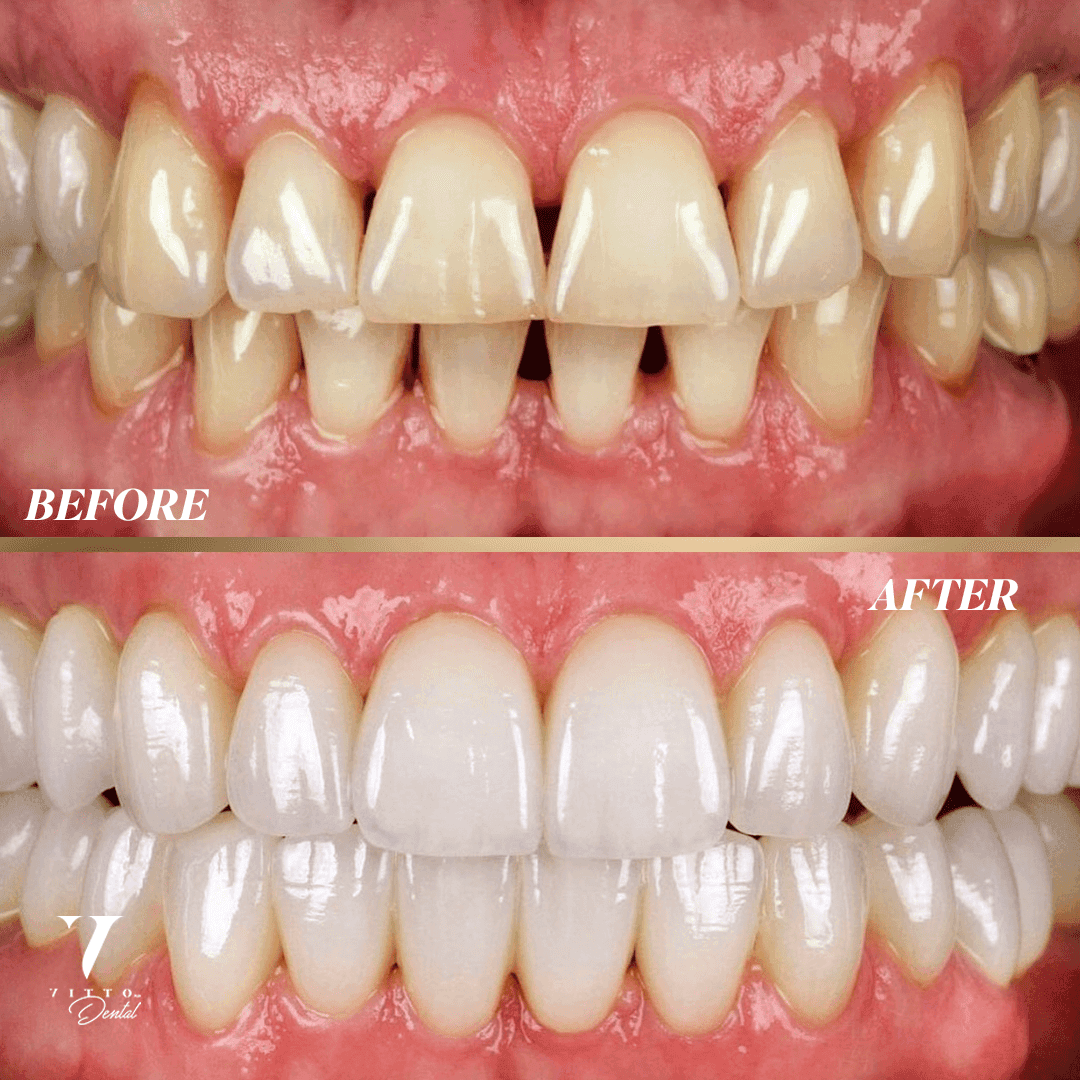 Before and after result at VittoMD in Miami, FL