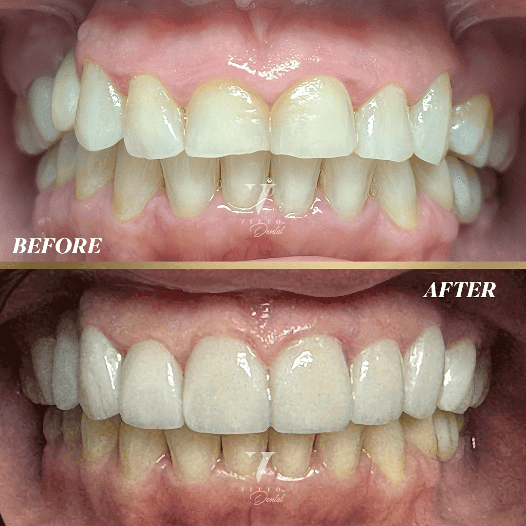 Before and after result at VittoMD in Miami, FL