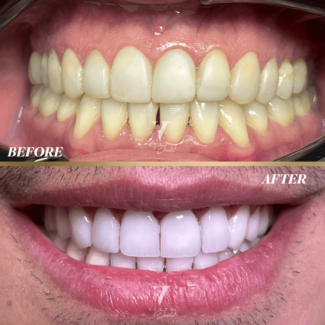 Before and after result at VittoMD in Miami, FL
