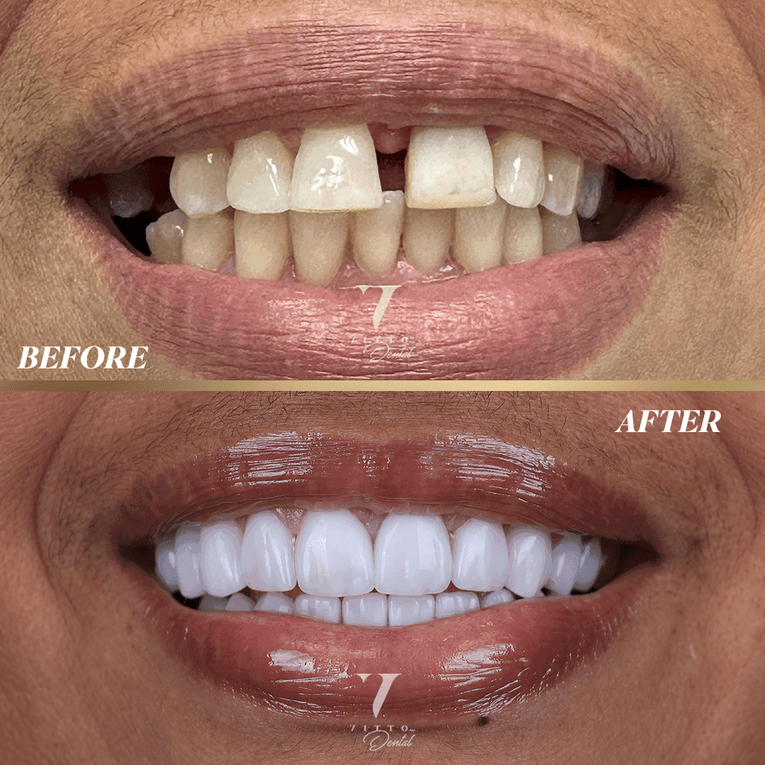 Before and after result at VittoMD in Miami, FL