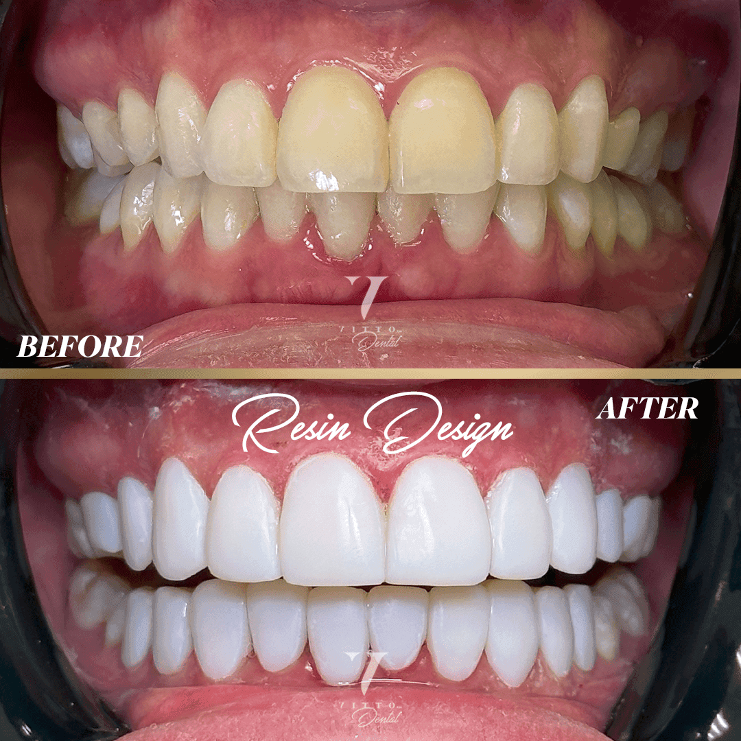 Before and after result at VittoMD in Miami, FL