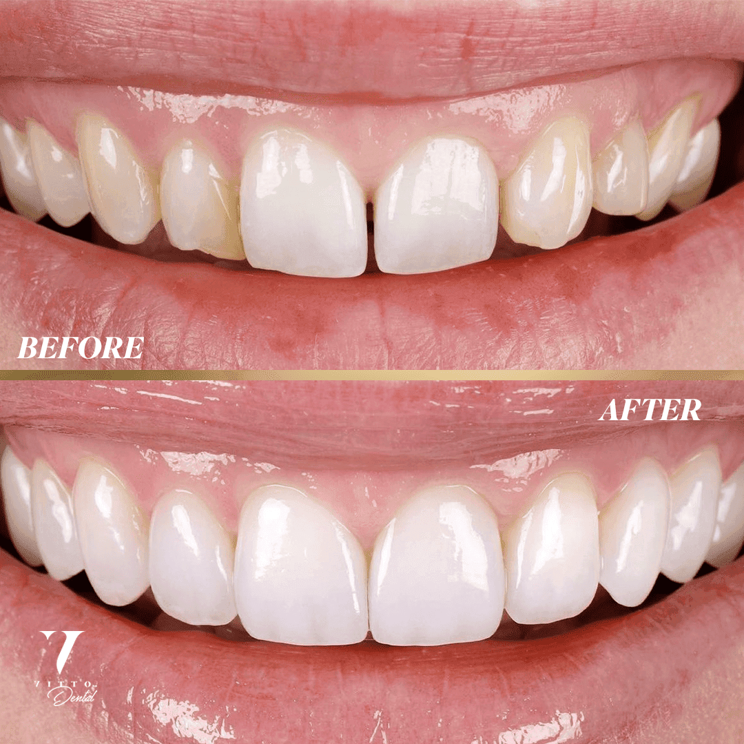 Before and after result at VittoMD in Miami, FL