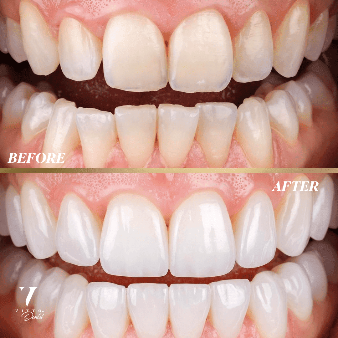 Before and after result at VittoMD in Miami, FL