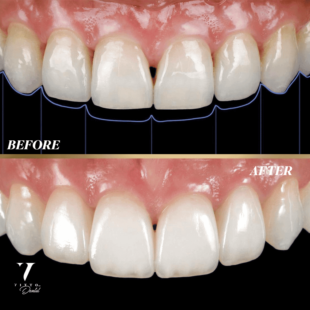 Before and after result at VittoMD in Miami, FL