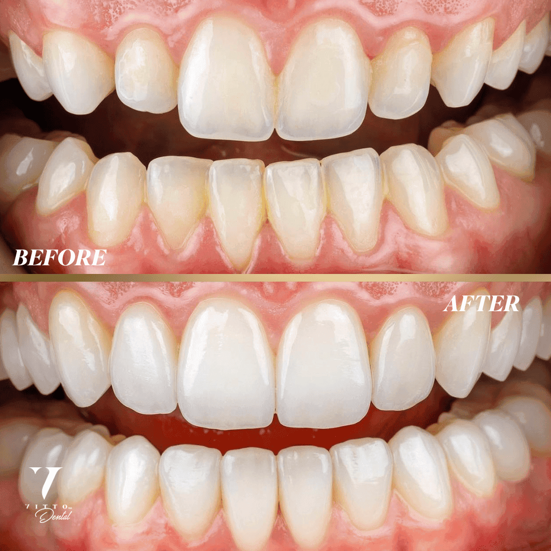 Before and after result at VittoMD in Miami, FL