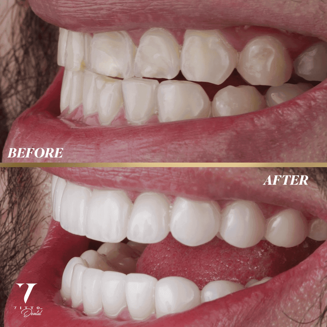 Before and after result at VittoMD in Miami, FL