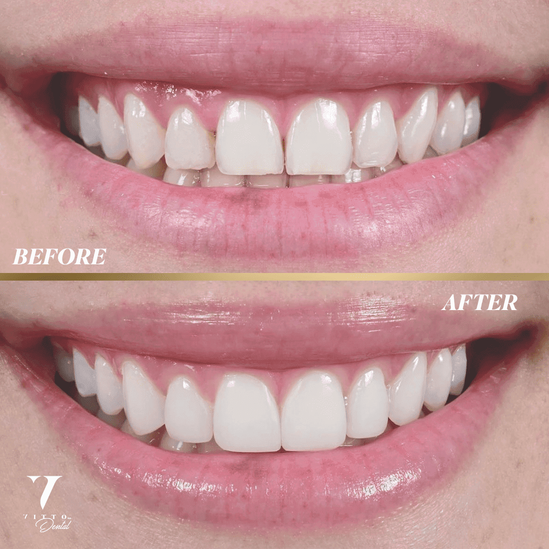 Before and after result at VittoMD in Miami, FL