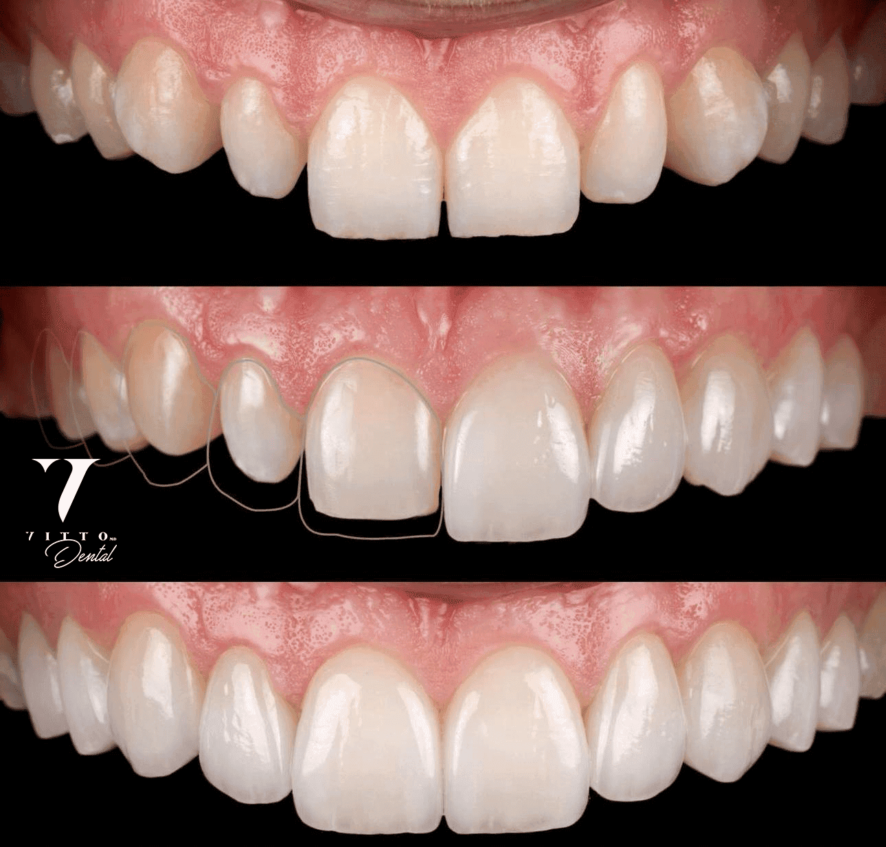 Before and after result at VittoMD in Miami, FL