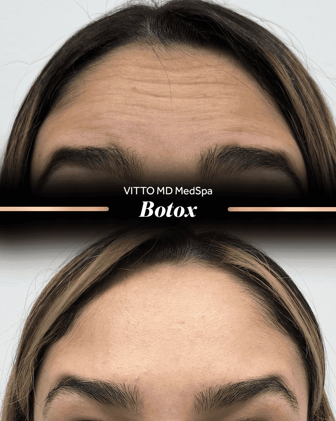 Before and after result at VittoMD in Miami, FL