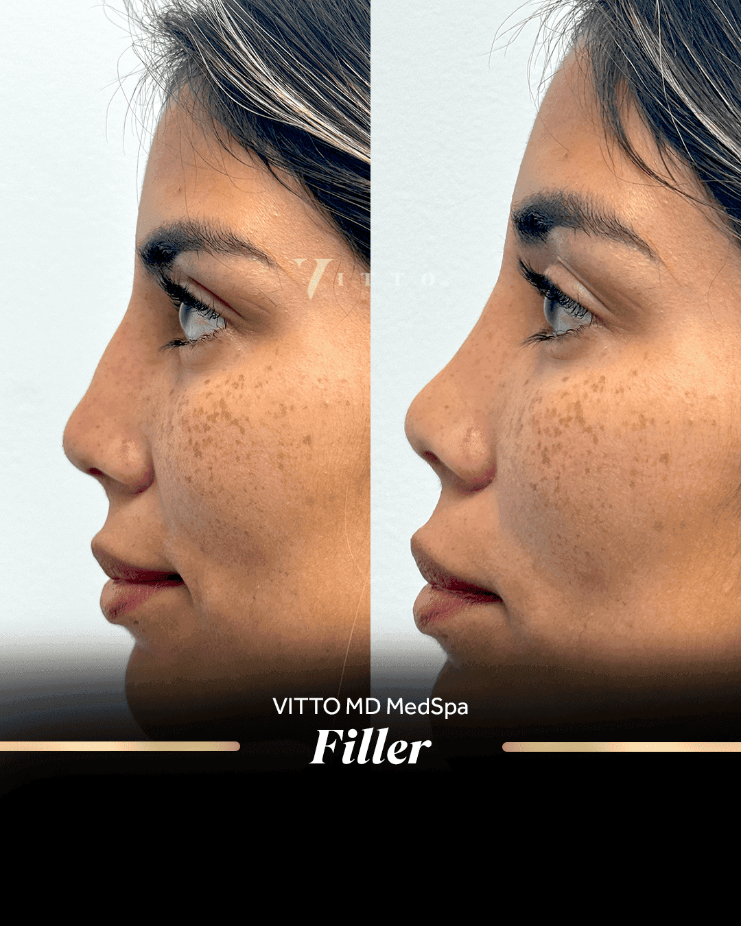Before and after result at VittoMD in Miami, FL