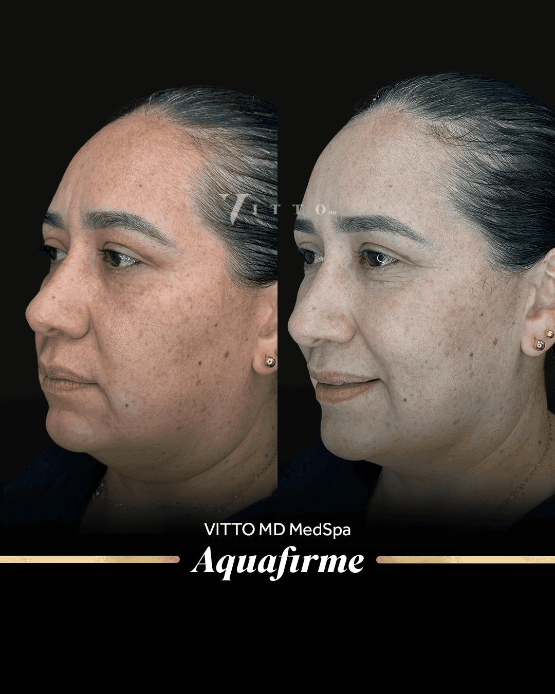 Before and after result at VittoMD in Miami, FL