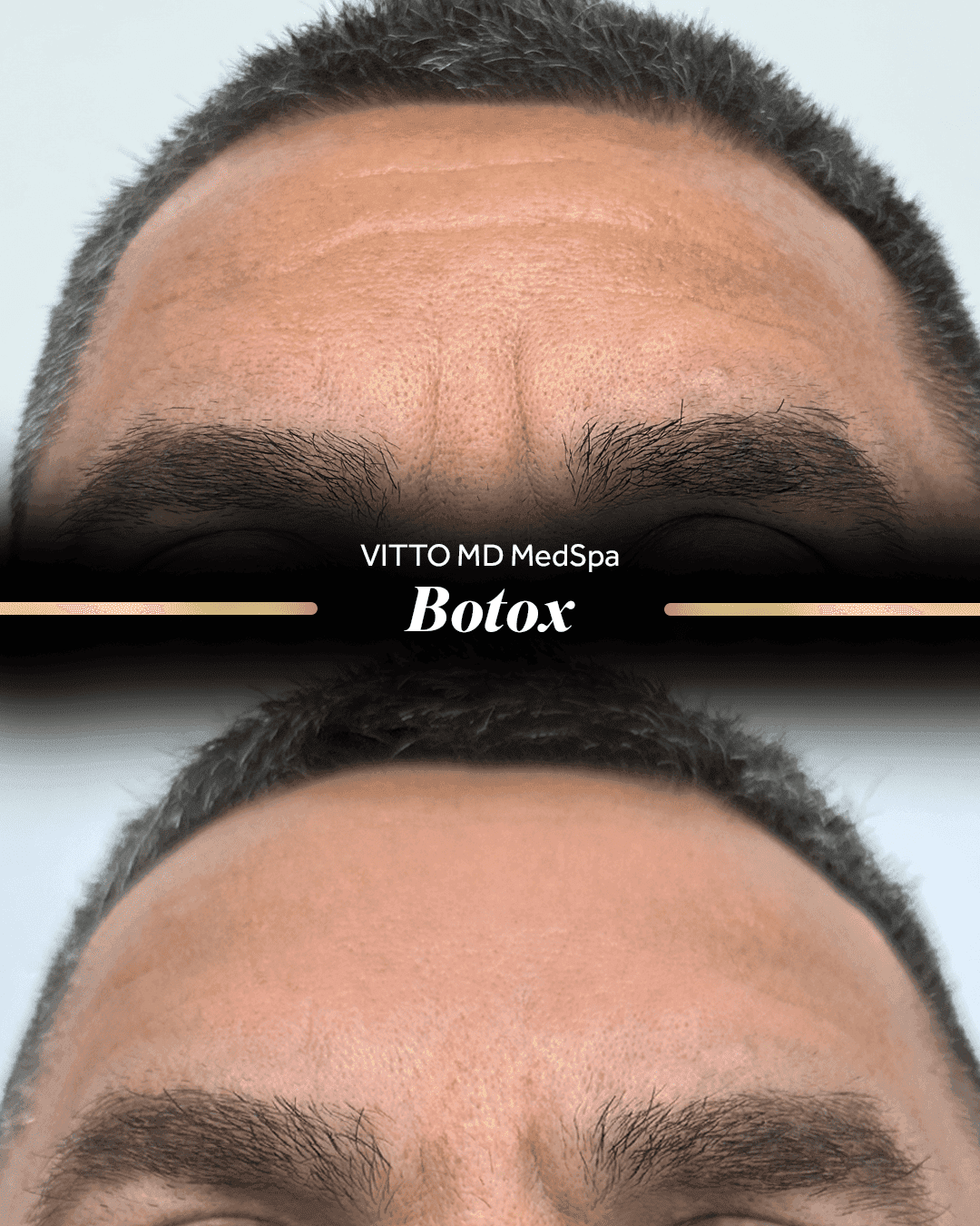 Before and after result at VittoMD in Miami, FL
