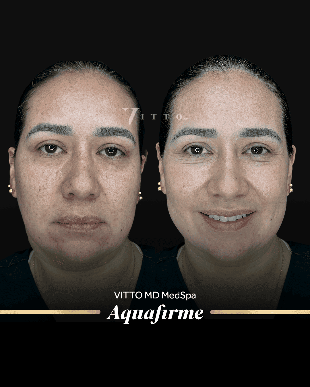 Before and after result at VittoMD in Miami, FL