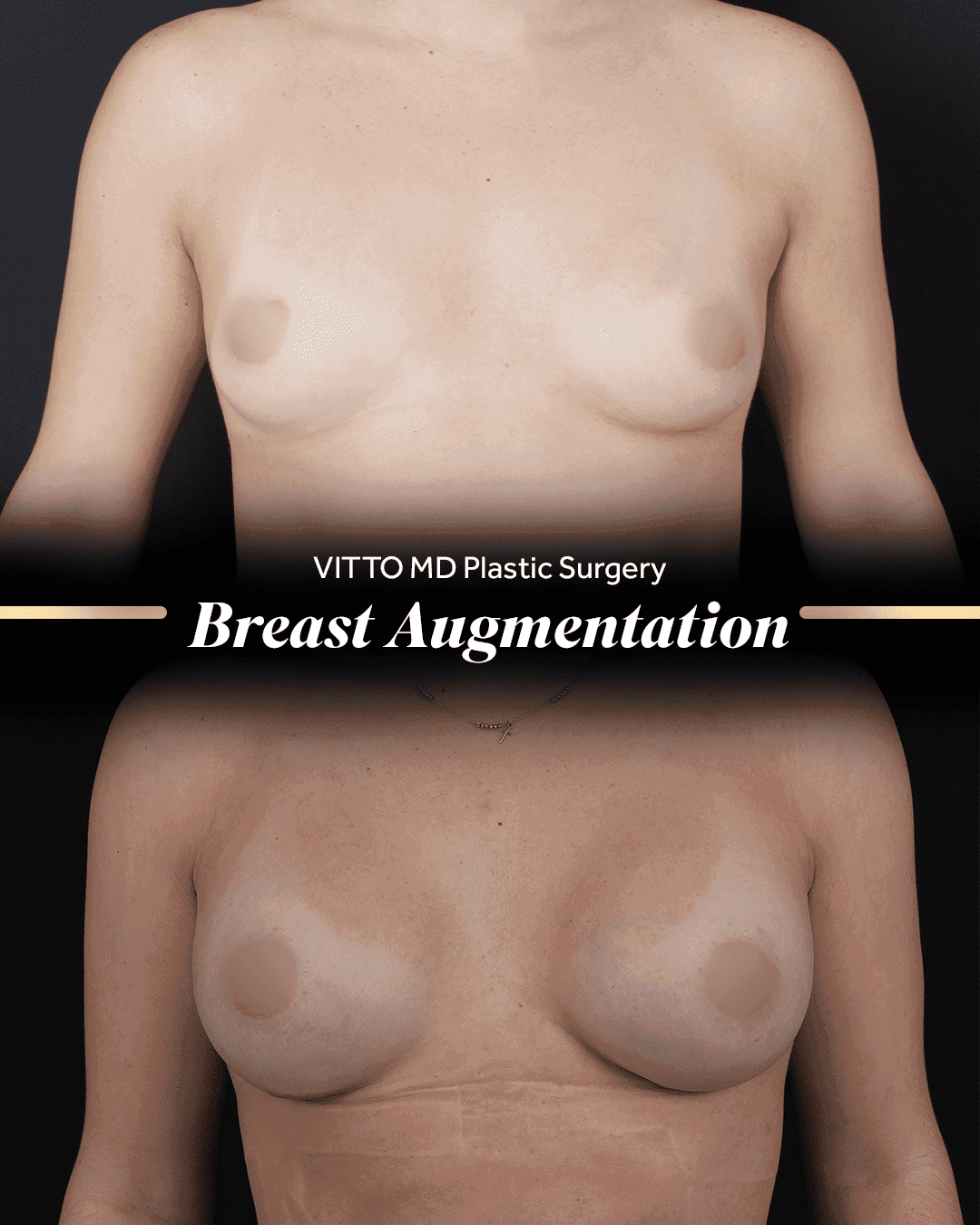 Before and after result at VittoMD in Miami, FL