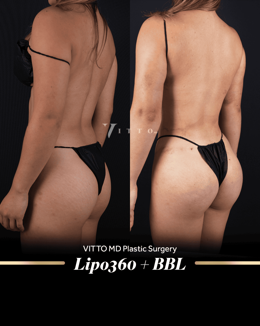 Resultados de Brazilian Butt Lift (BBL) - 1