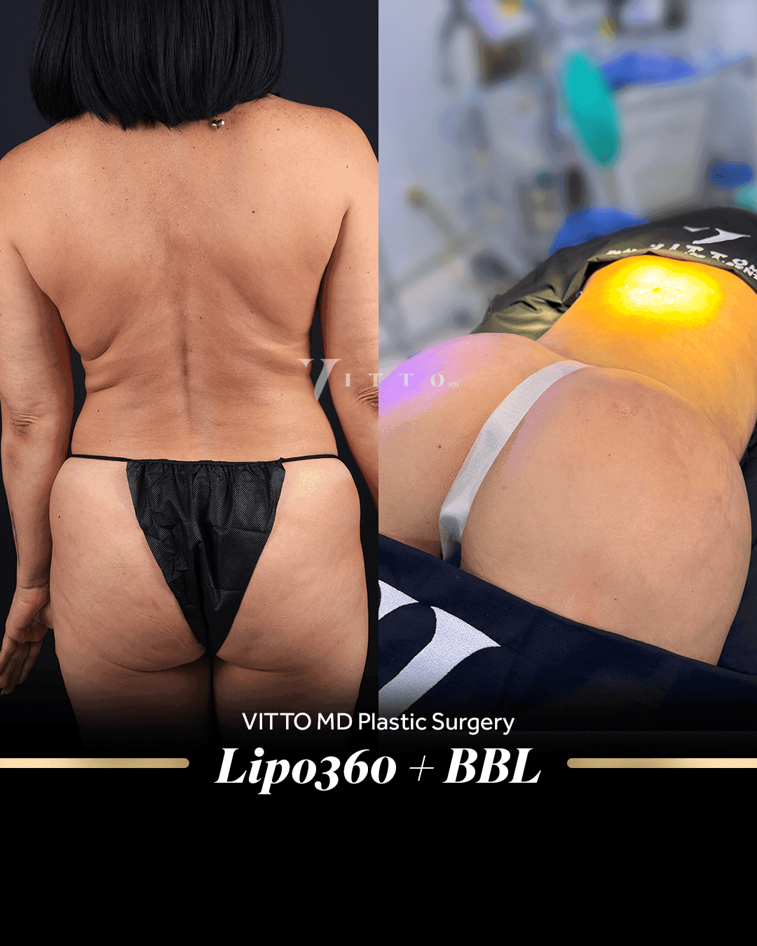 Before and after result at VittoMD in Miami, FL