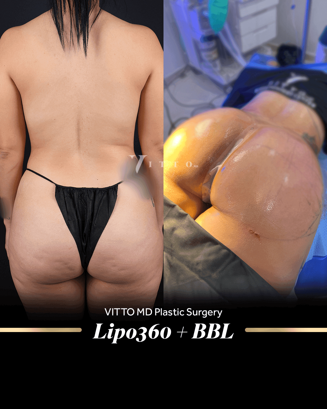 Before and after result at VittoMD in Miami, FL