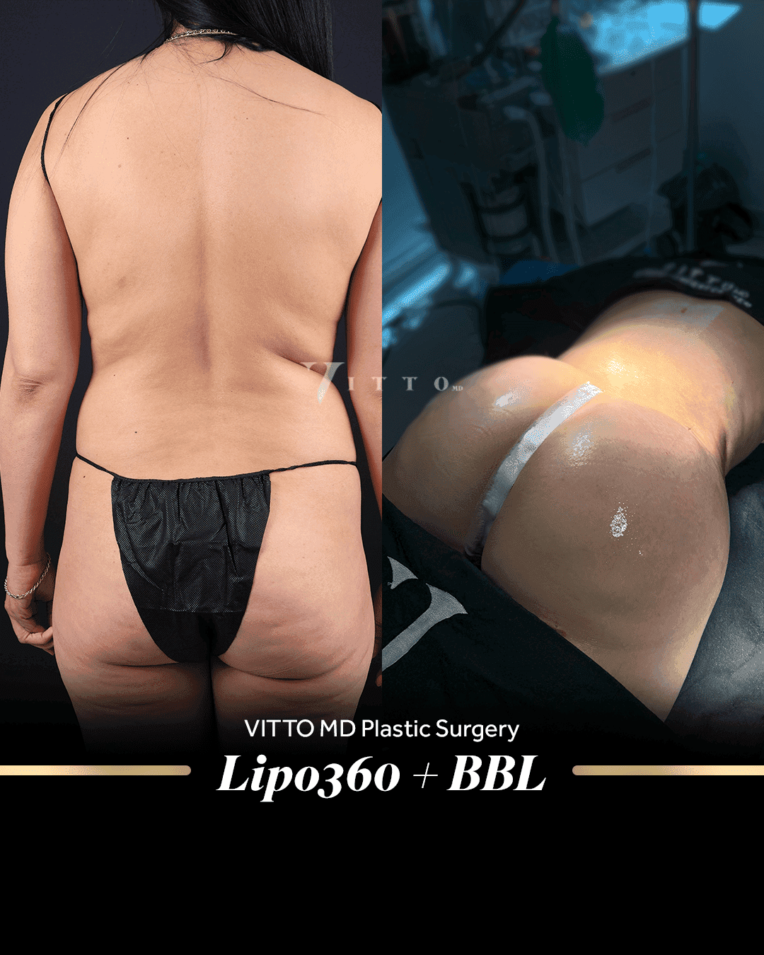 Before and after result at VittoMD in Miami, FL