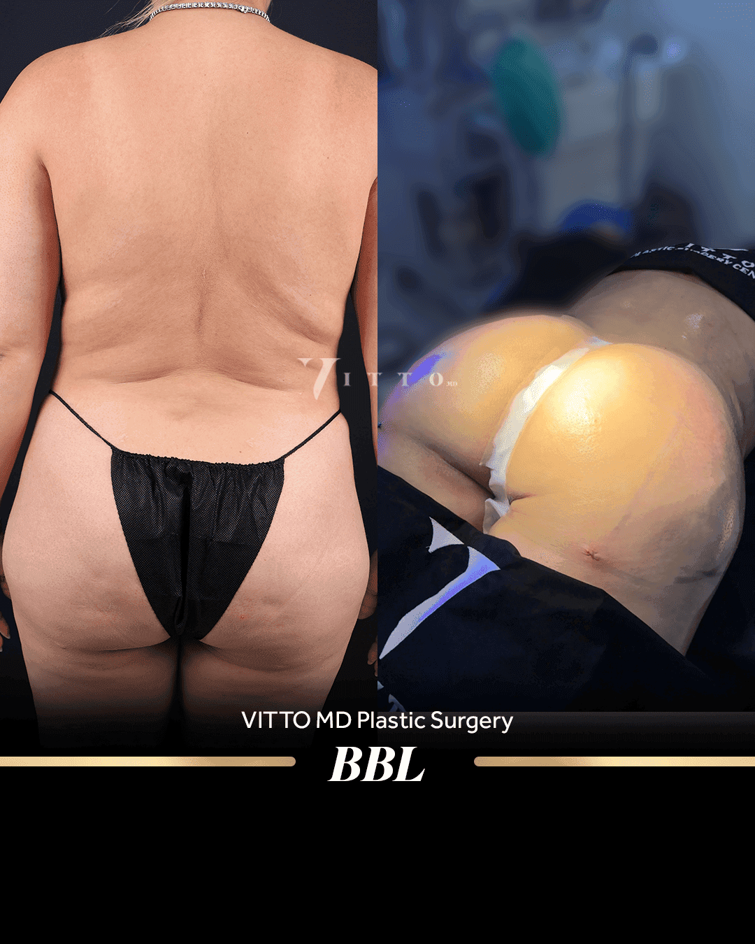 Before and after result at VittoMD in Miami, FL