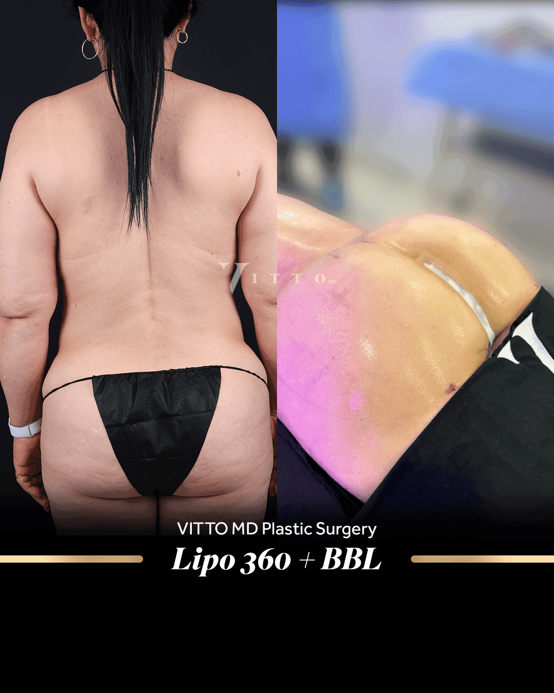 Before and after result at VittoMD in Miami, FL