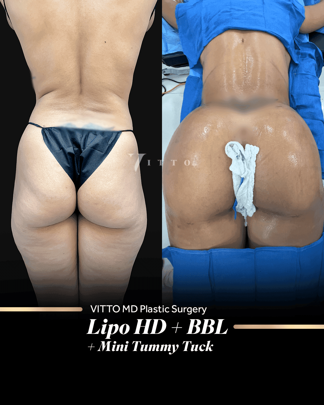 Before and after result at VittoMD in Miami, FL