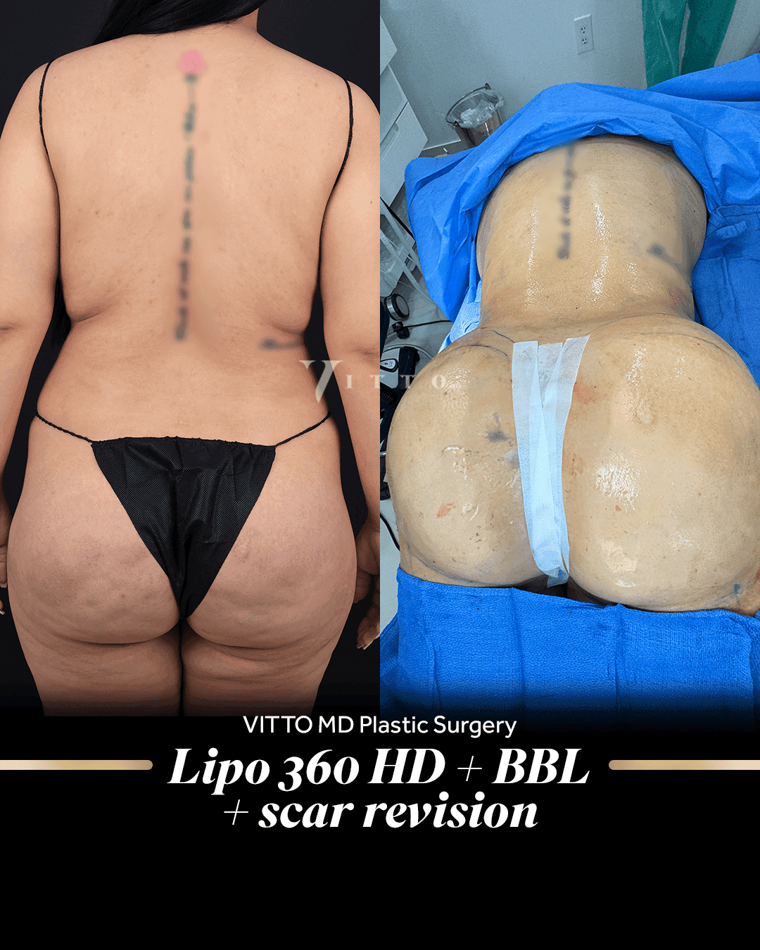 Before and after result at VittoMD in Miami, FL