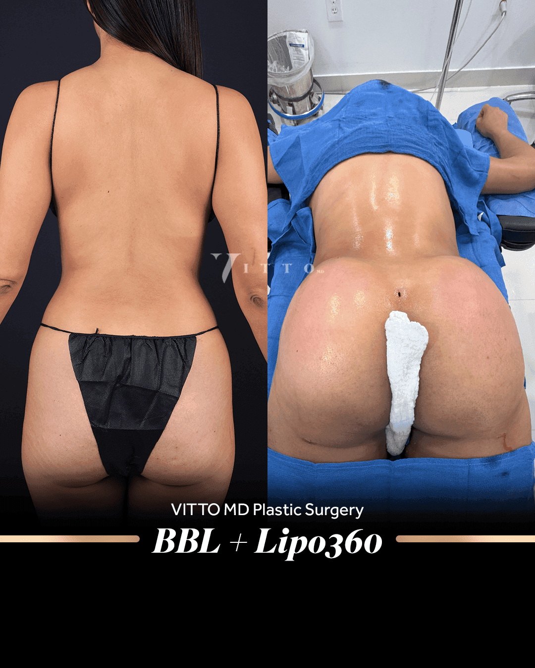 Before and after result at VittoMD in Miami, FL