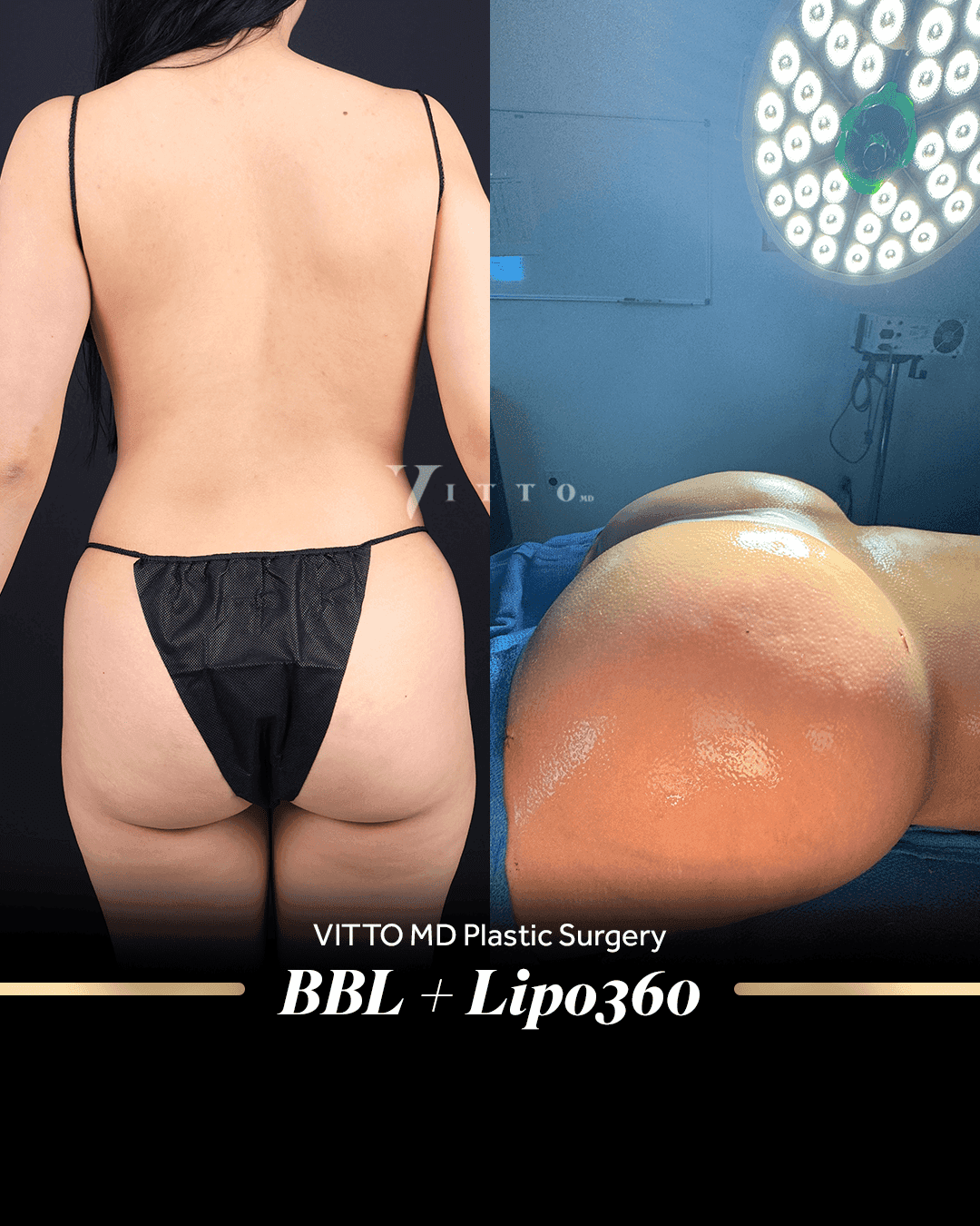 Before and after result at VittoMD in Miami, FL