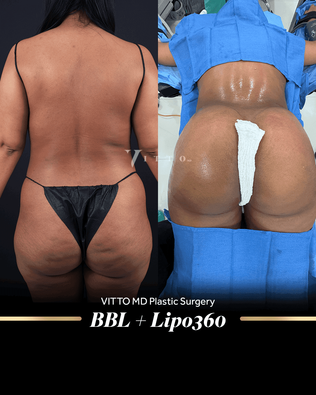 Before and after result at VittoMD in Miami, FL