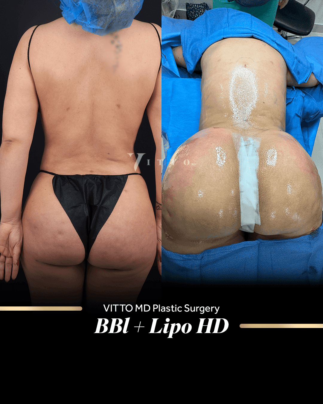 Before and after result at VittoMD in Miami, FL